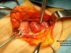 Küçük kesiyle paratiroid ameliyatı