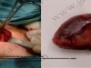 Küçük kesiyle boyundan paratiroid adenomu ameliyatı