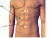 laparascopic_choecystectomy