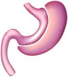 Sleeve Gastrectomy (Obesıty Surgery)